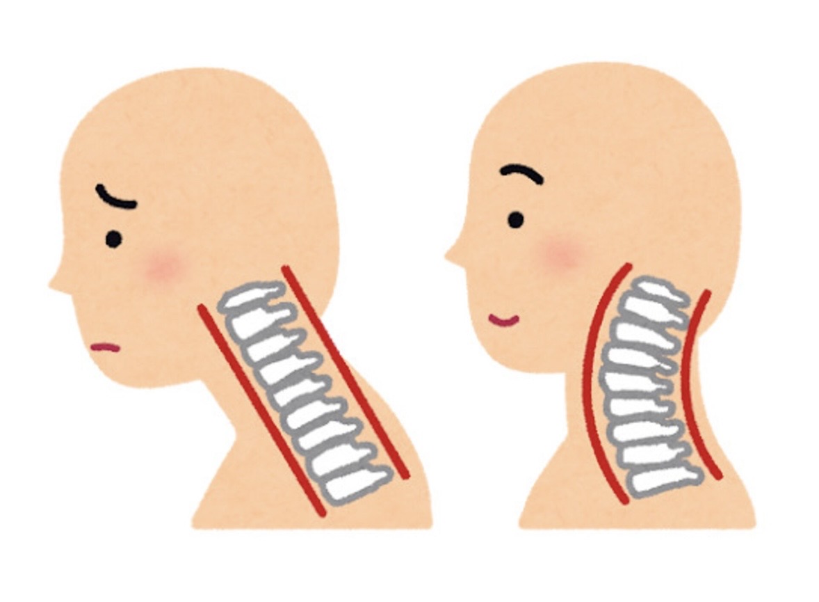 ストレートネックによる首・頭の違和感